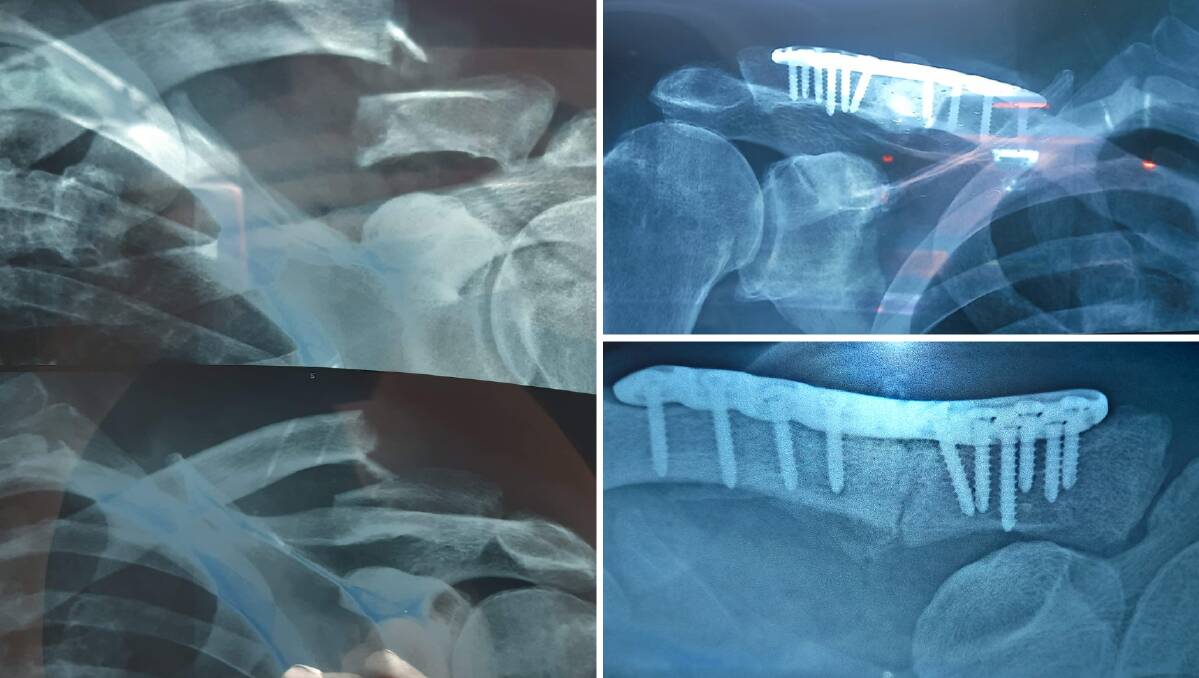 Sean Griffiths' injuries included snapping both collarbones. It required surgery with a titanium plate put in place. Pictures supplied
